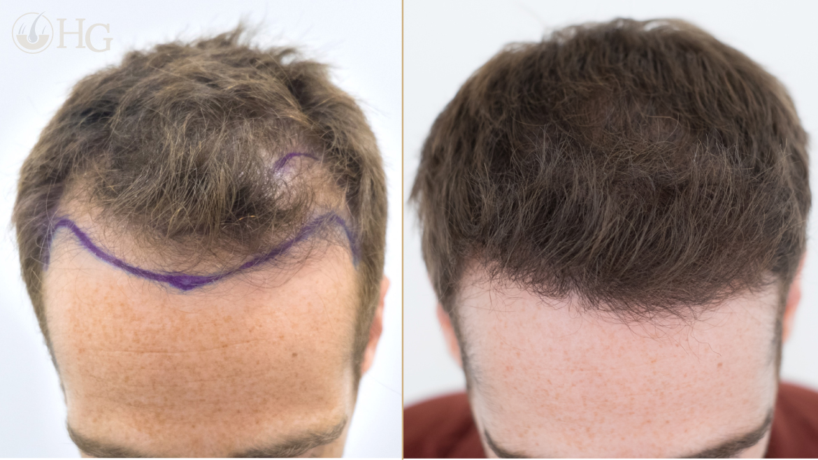 Hair Transplant